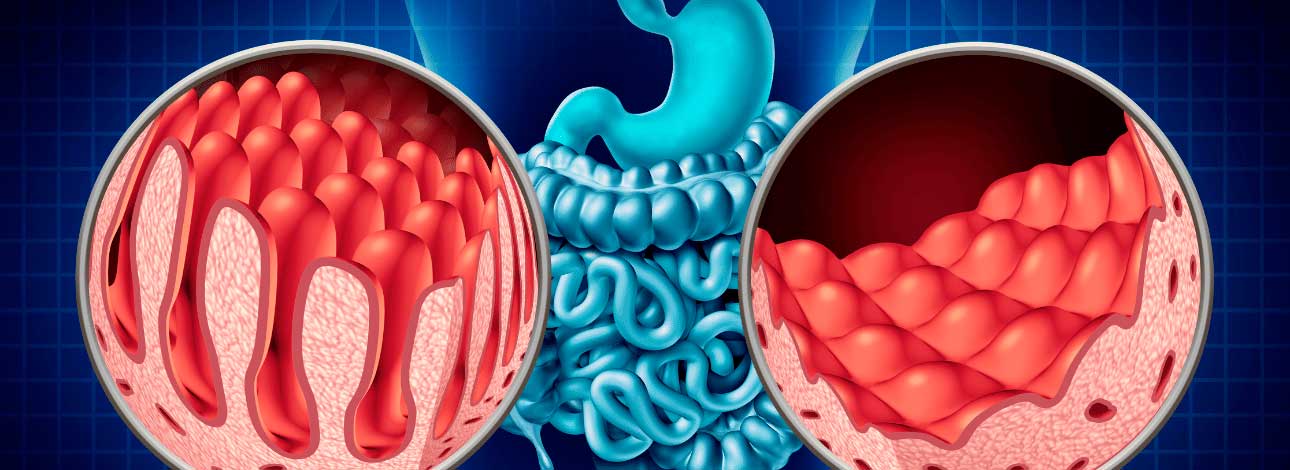 spx-clinica-spx-imagem-o-que-e-a-doenca-celíaca