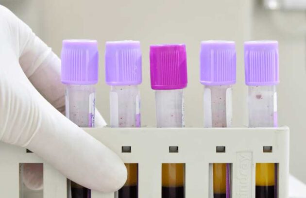 spx-clinica-spx-imagem-o-que-e-o-hemograma-completo