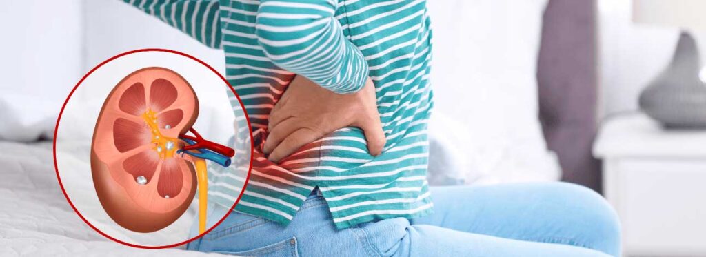 spx-clinica-spx-imagem-evitar-pedra-nos-rins