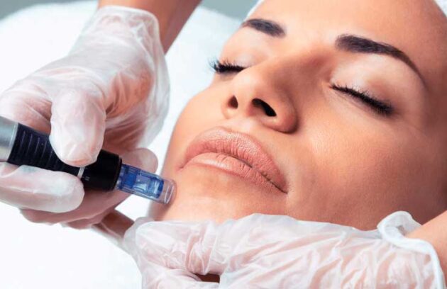 spx-clinica-spx-imagem-microagulhamento-facial