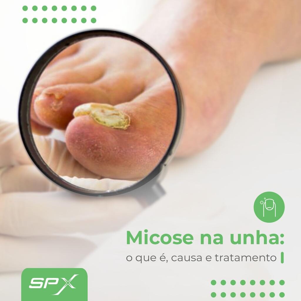 spx clinica spx imagem Micose na unha: o que é, causa e tratamento
