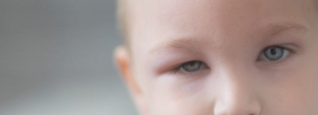 spx-clinica-spx-imagem-olho-inchado-o-que-pode-ser