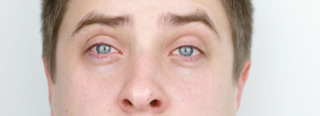 Spx-clinica-spx-imagem-Como-evitar-a-sindrome-dos-Olhos-Secos-2