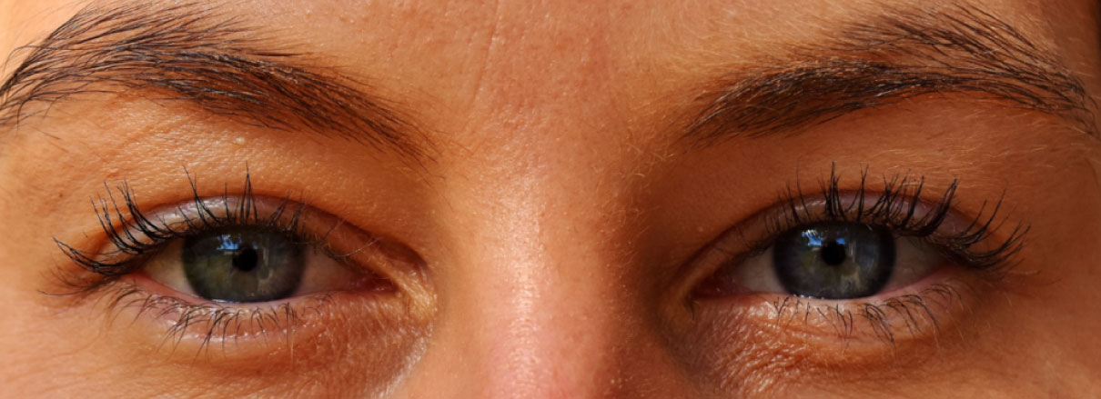 Spx-clinica-spx-imagem-Como-evitar-a-sindrome-dos-Olhos-Secos