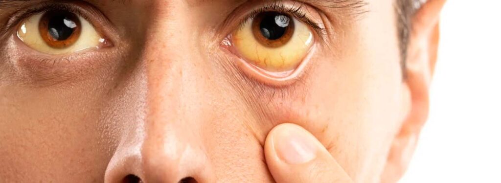 spx clinica spx imagem Hepatites Virais o que sao blog artigo