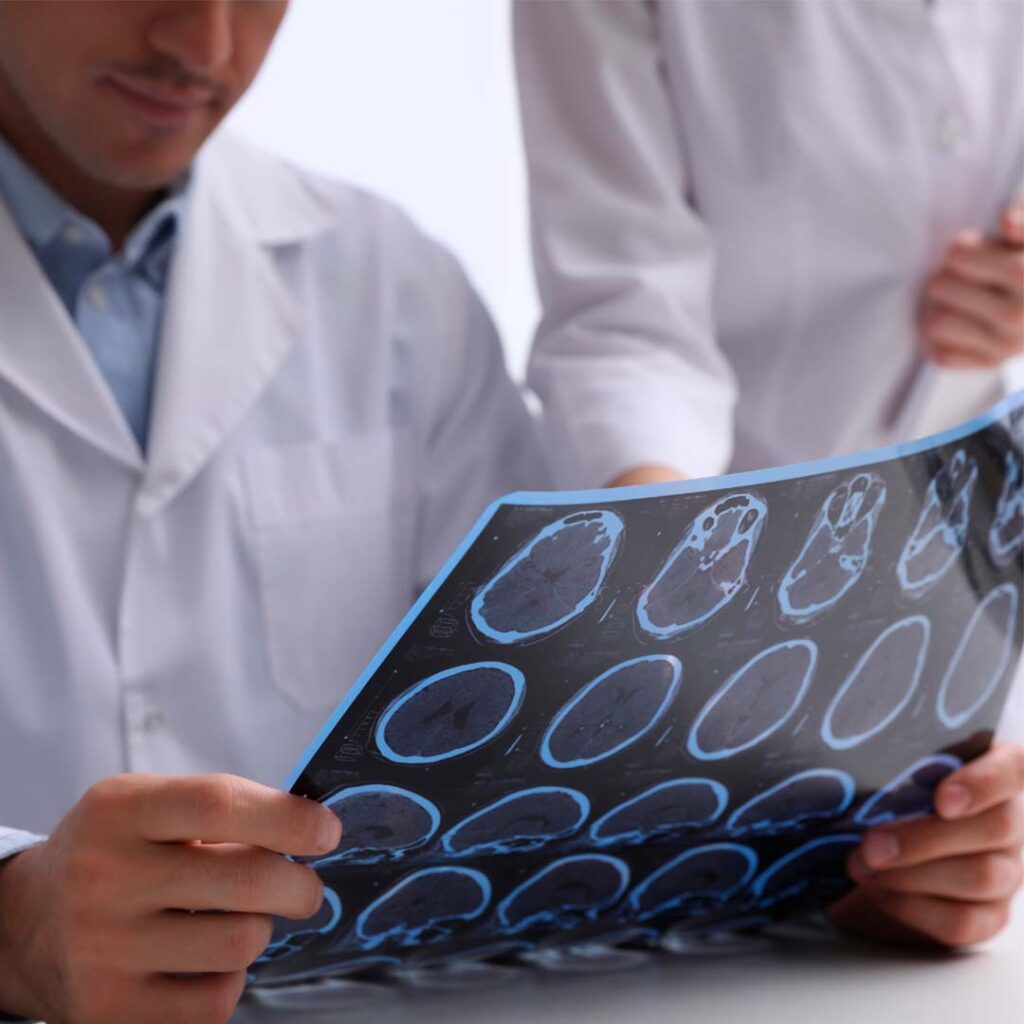 spx clinica spx imagem blog artigo Esclerose Multipla: o que voce precisa saber