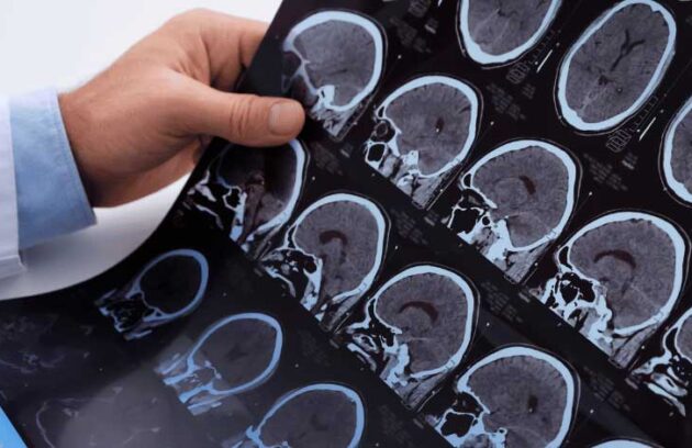 Médico analisando resultado de exame de paciente com esclerose múltipla