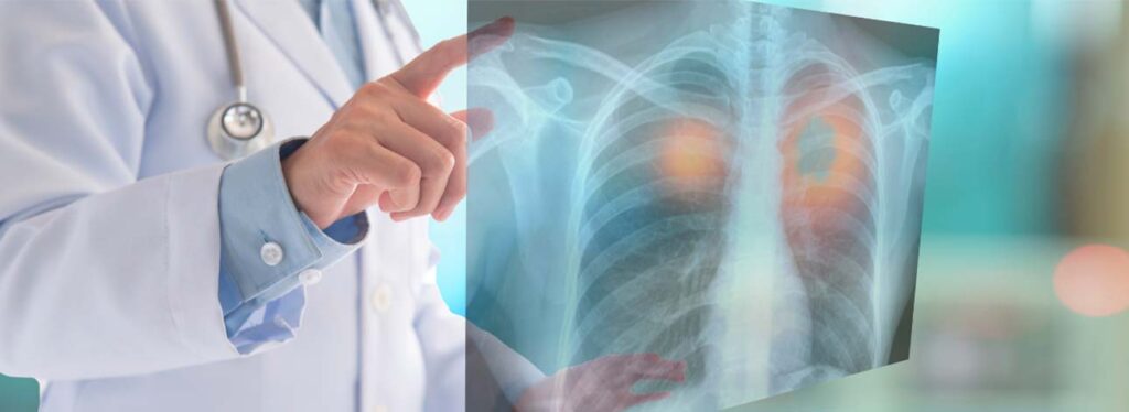 spx imagem spx clinica Saiba tudo sobre a descoberta que vai revolucionar o combate ao cancer de pulmao saude medicina artigo