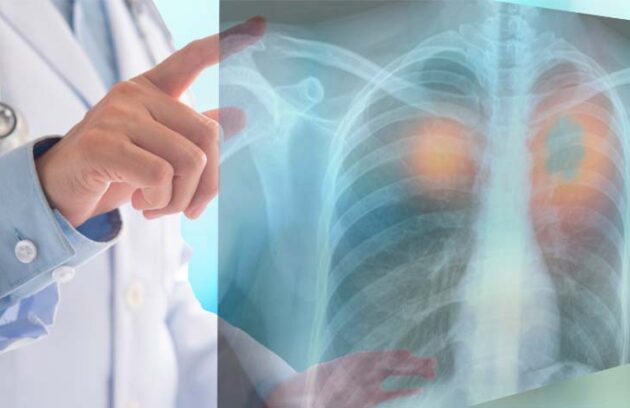 spx imagem spx clinica Saiba tudo sobre a descoberta que vai revolucionar o combate ao cancer de pulmao saude medicina artigo