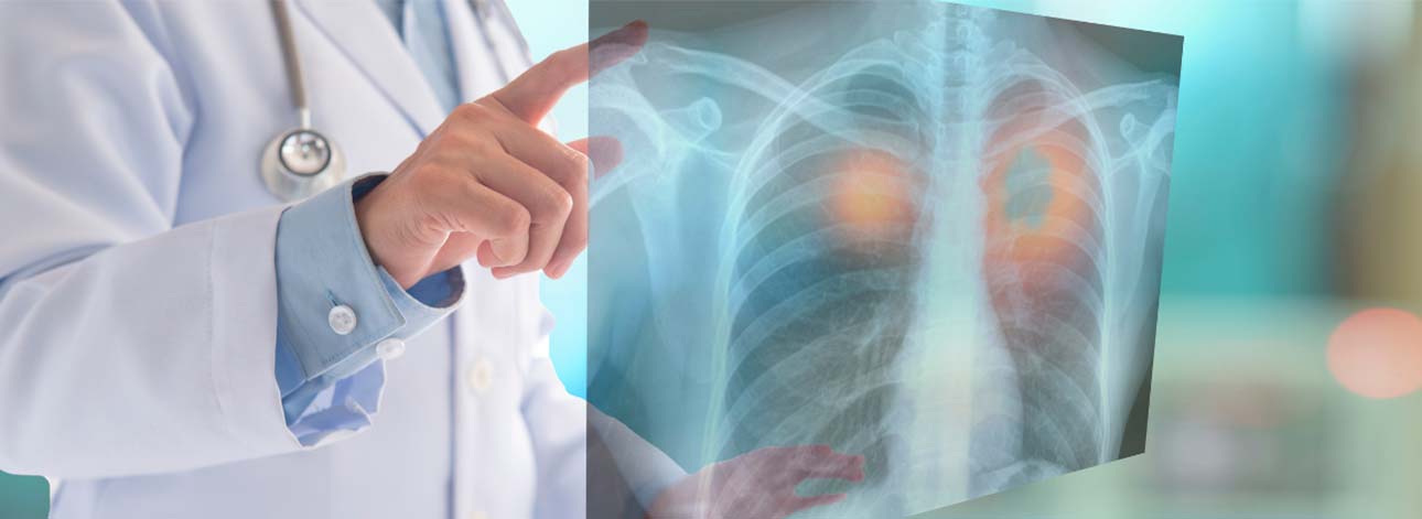 spx imagem spx clinica Saiba tudo sobre a descoberta que vai revolucionar o combate ao cancer de pulmao saude medicina artigo