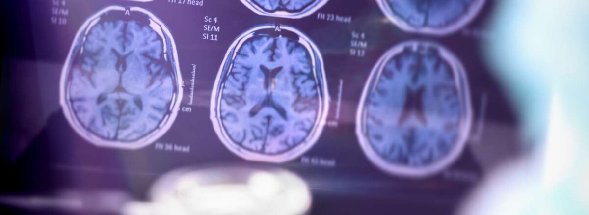 spx-clinica-spx-imagem-diagnóstico-alzheimer (2)