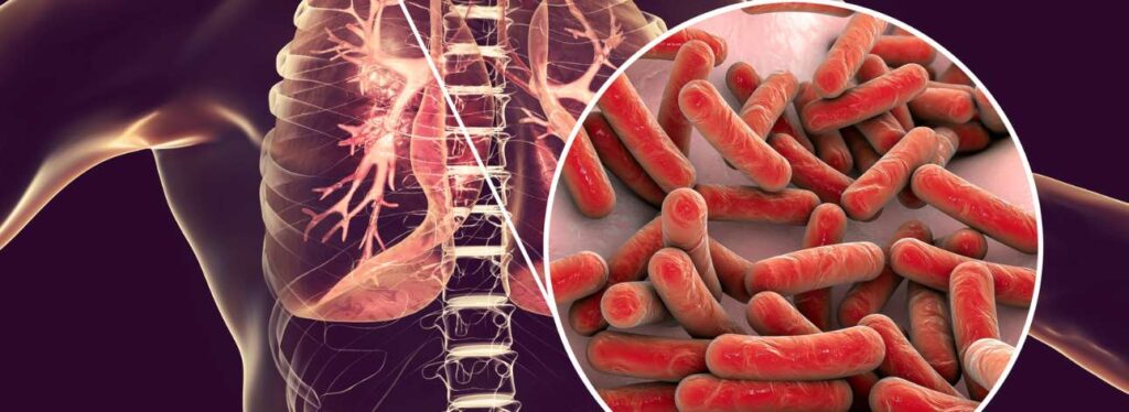 spx-clinica-spx-imagem-tuberculose- aumento-casos (2)