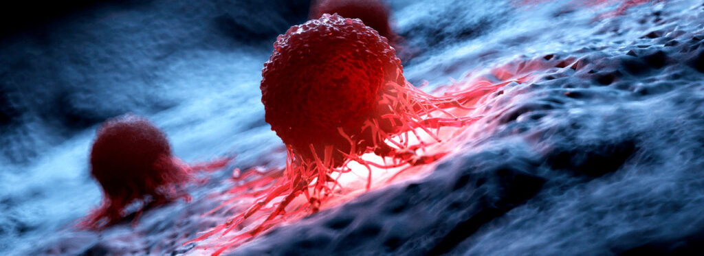 spx-clinica-spx-imagem-IA-tumores-cerebrais