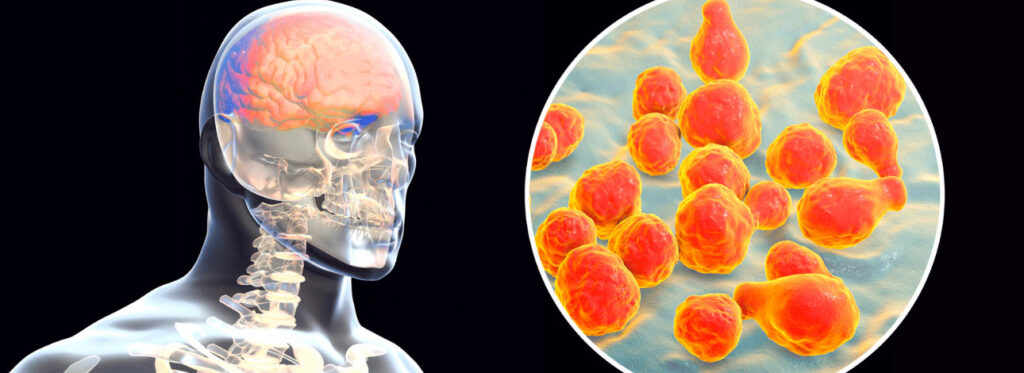 spx-clinica-spx-imagem-fungos-no-cerebro-e-sintomas-de-alzheimer