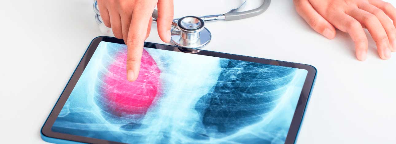 spx-clinica-spx-imagem-estudo-cancer-pulmonar