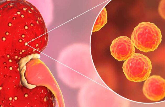 spx-clinica-spx-imagem-o-que-e-infeccao-renal