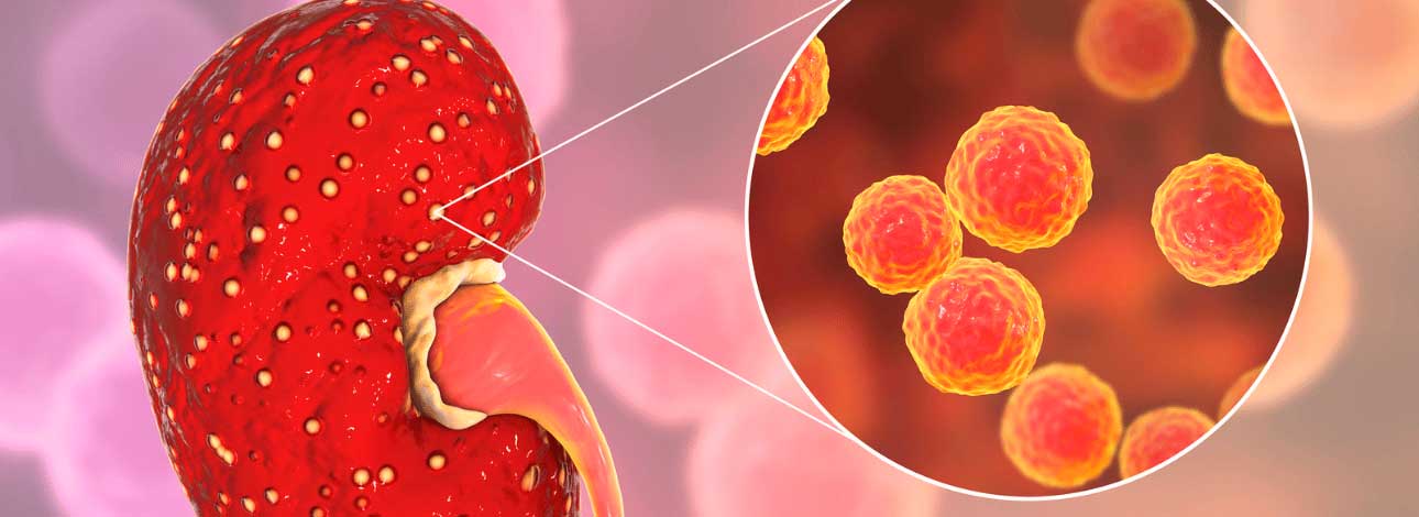 spx-clinica-spx-imagem-o-que-e-infeccao-renal