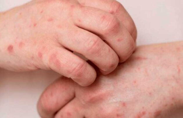 spx-clinica-spx-imagem-aumentos-dos-casos-de-sifilis-spx