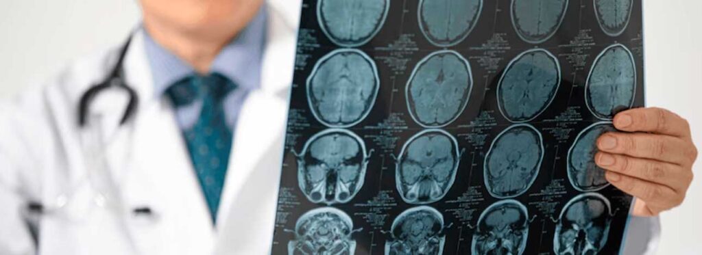 spx-clinica-spx-imagem-relacao-entre-a-doenca-de-alzheimer-e-o-diabetes