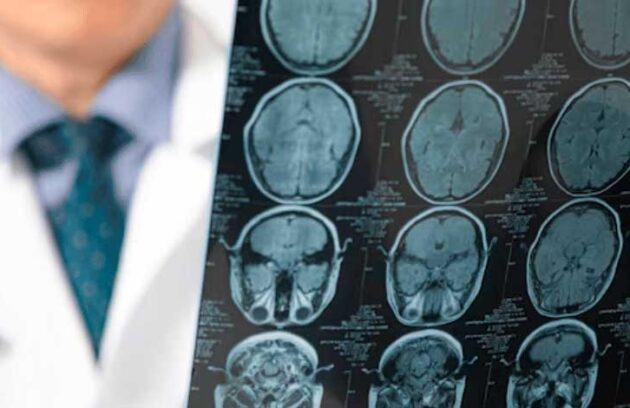 spx-clinica-spx-imagem-relacao-entre-a-doenca-de-alzheimer-e-o-diabetes