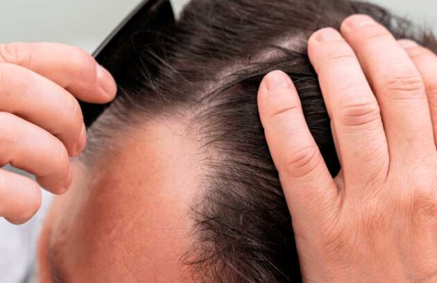 spx-clinica-spx-imagem-terapia-capilar-pode-combater-a-calvicie-spx