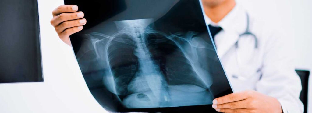 spx-clinica-spx-imagem-mecanismo-que-agrava-tuberculose