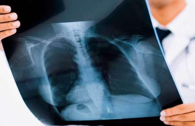 spx-clinica-spx-imagem-mecanismo-que-agrava-tuberculose
