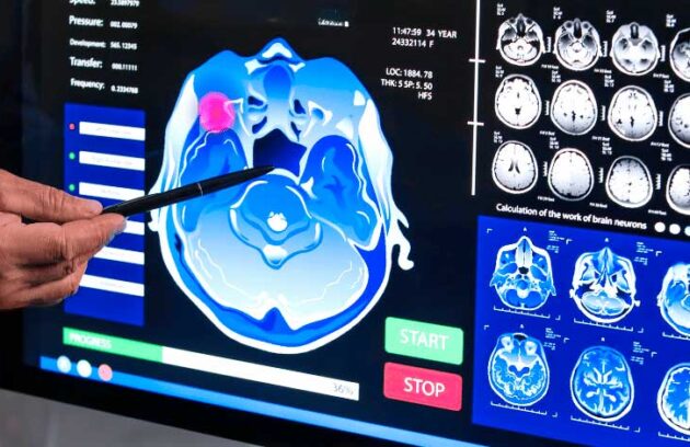 spx-clinica-spx-imagem-proteinas-podem-prever-demencia