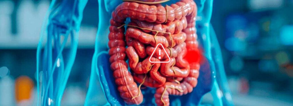 spx-clinica-spx-imagem-crescimento-de-cancer-colorretal