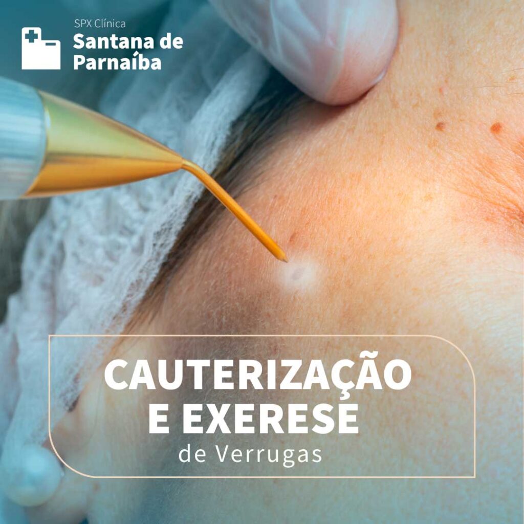 cauterizazao-exerese-verrugas-spx-clinica_(2)