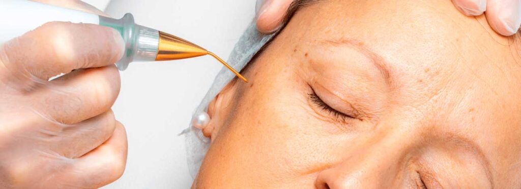 spx-clinica-spx-imagem-cauterizacao-e-exerese-de-verrugas