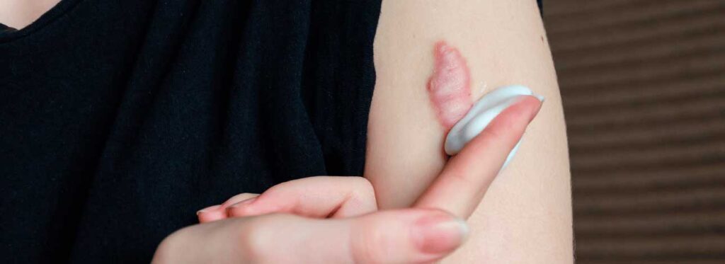 spx-clinica-spx-imagem-dicas-para-promover-a-cicatrizacao-da-pele