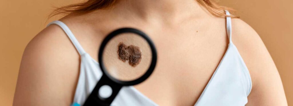 spx-clinica-spx-imagem-diferencas-entre-os-tipos-de-cancer-de-pele