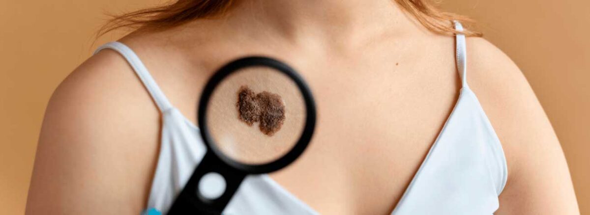 spx-clinica-spx-imagem-diferencas-entre-os-tipos-de-cancer-de-pele