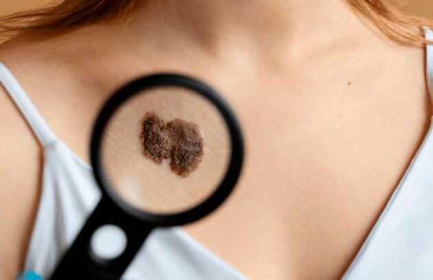 spx-clinica-spx-imagem-diferencas-entre-os-tipos-de-cancer-de-pele