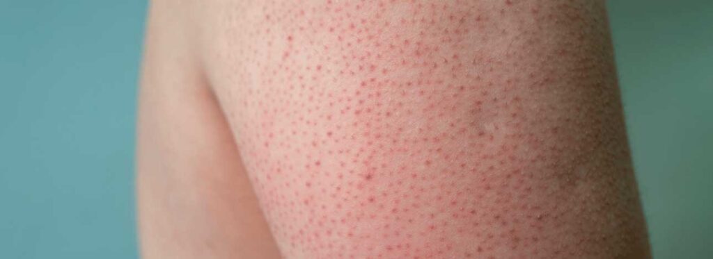 spx-clinica-spx-imagem-como-identificar-queratose-pilar