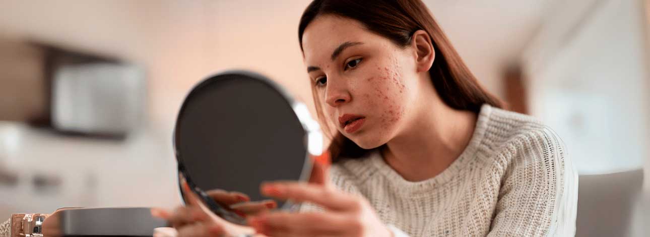 spx-clinica-spx-imagem-como-se-define-acne-severa