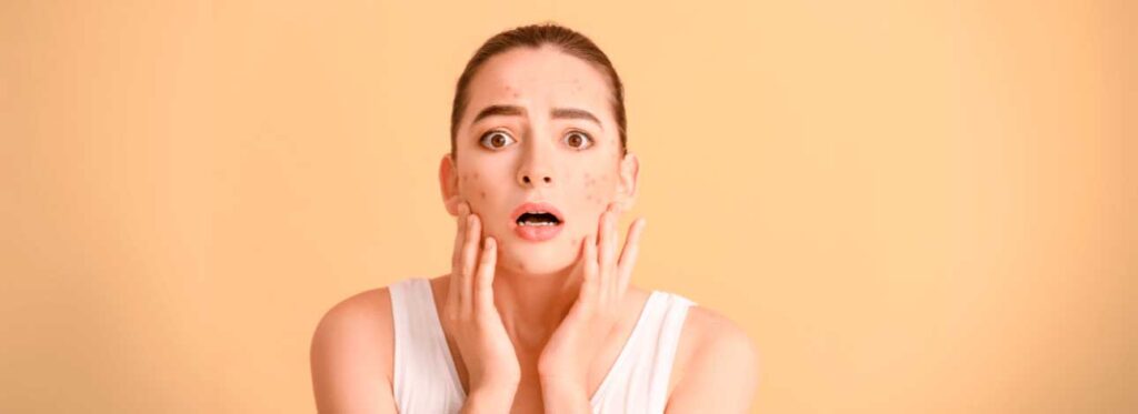 spx-clinica-spx-imagem-como-tratar-acne-severa