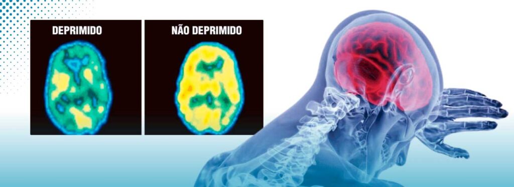 spx-clinica-spx-imagem-depressao-pode-causar-danos-ao-cerebro