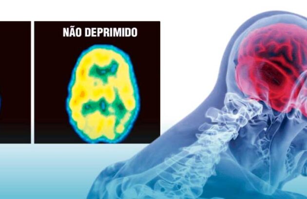 spx-clinica-spx-imagem-depressao-pode-causar-danos-ao-cerebro