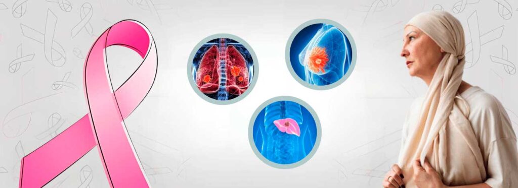 spx-clinica-spx-imagem-tipos-de-cancer-mais-letais