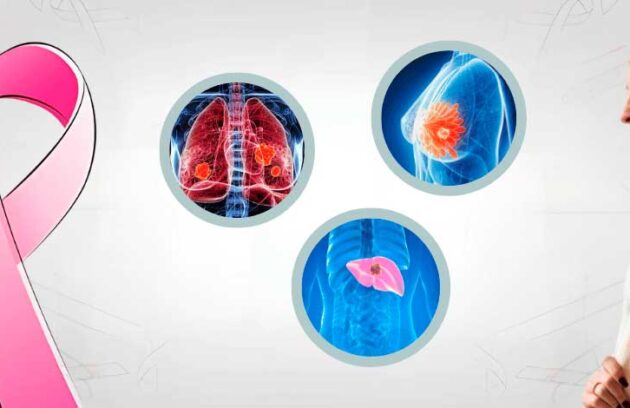 spx-clinica-spx-imagem-tipos-de-cancer-mais-letais