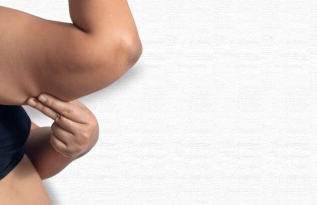 spx-clinica-spx-imagem-como-identificar-o-lipedema