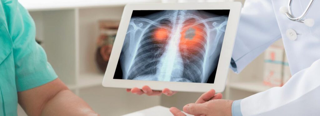 spx-clinica-spx-imagem-novo-gene-no-cancer-de-pulmao