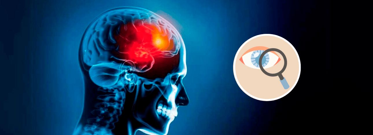 spx-clinica-spx-imagem-qual-exame-ocular-pode-prever-risco-de-avc