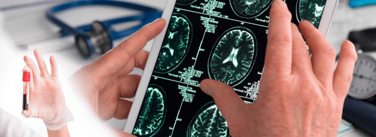 spx-clinica-spx-imagem-exame-brasileiro-detecta-alzheimer