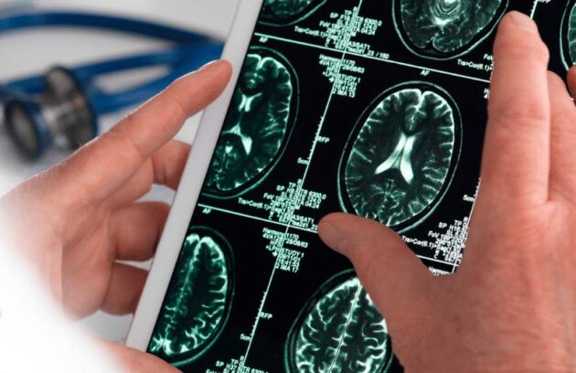 spx-clinica-spx-imagem-exame-brasileiro-detecta-alzheimer