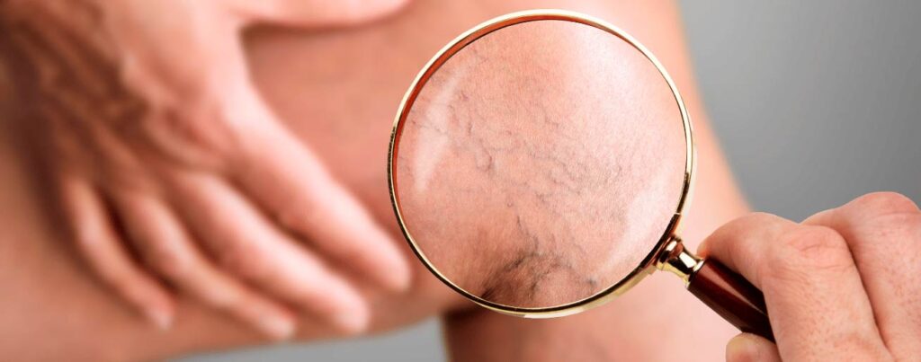 spx-clinica-spx-imagem-varizes-dores-e-inchaço-nas-pernas