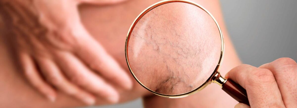 spx-clinica-spx-imagem-varizes-dores-e-inchaço-nas-pernas