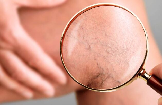 spx-clinica-spx-imagem-varizes-dores-e-inchaço-nas-pernas